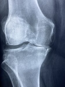 Knie Röntgen Arthrose