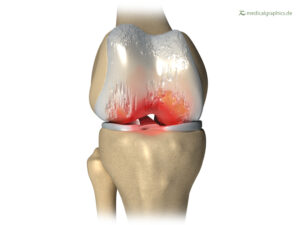 Knie frontal Arthrose